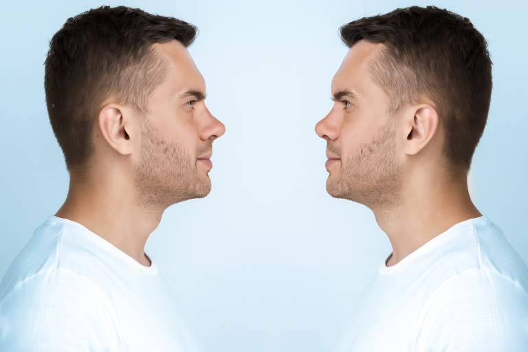 greek-nose