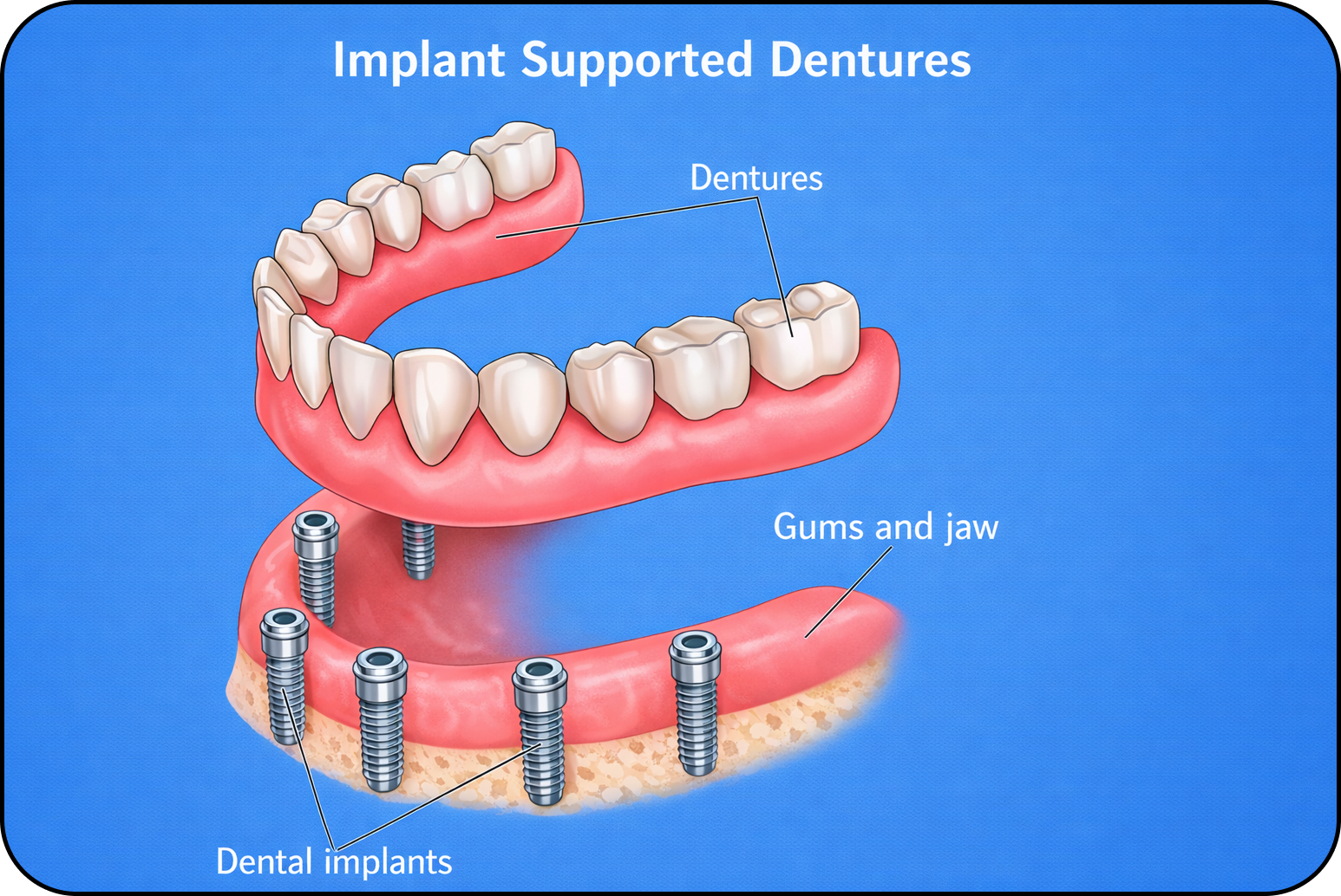 Implant supported dentures (3)