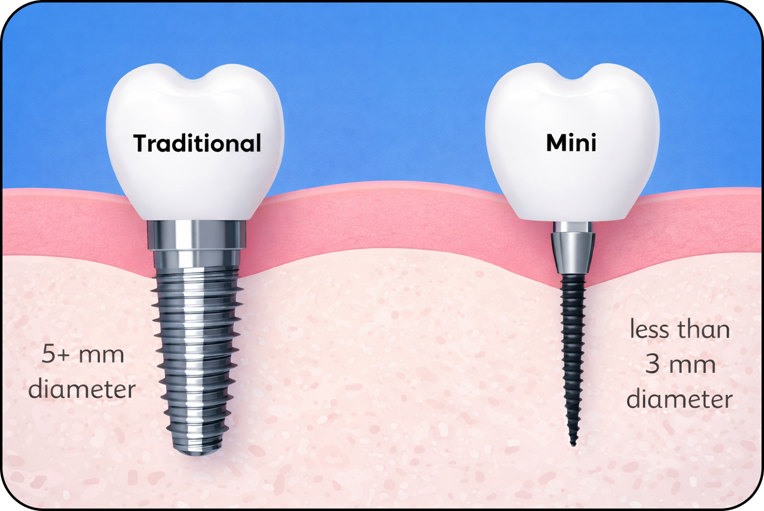 Mini Dental Implants