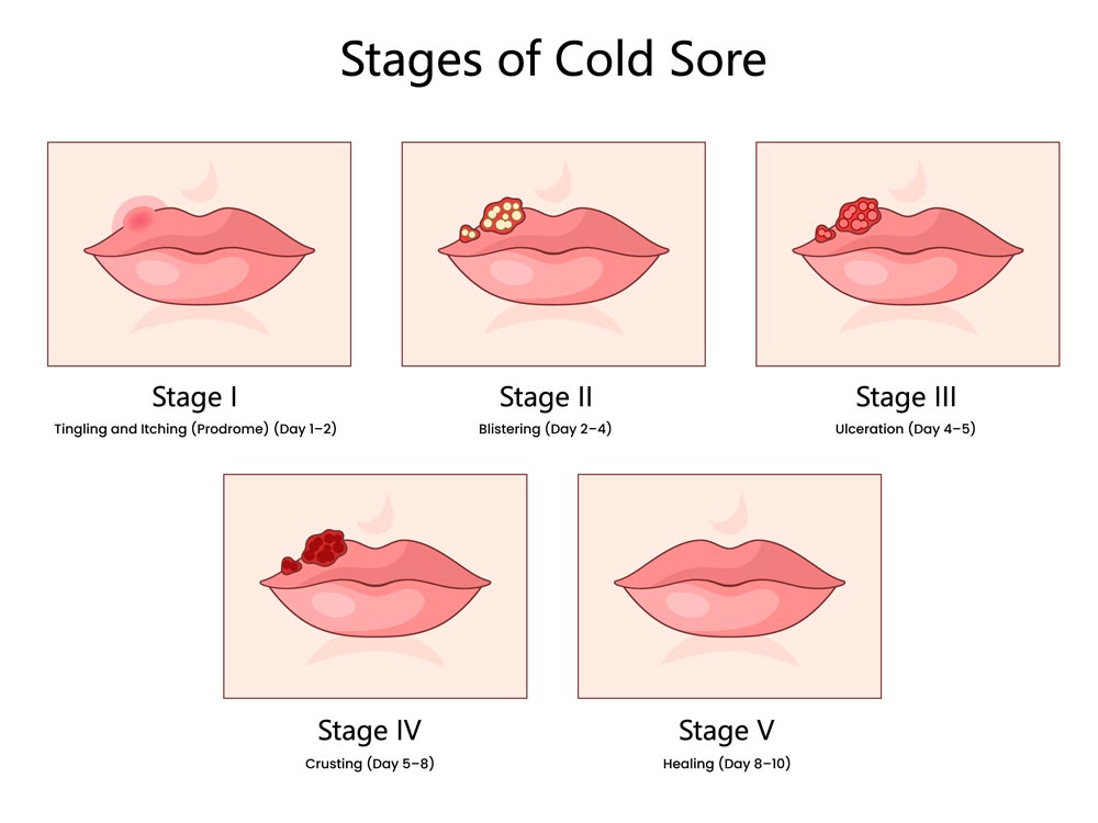 Stages of a Cold Sore