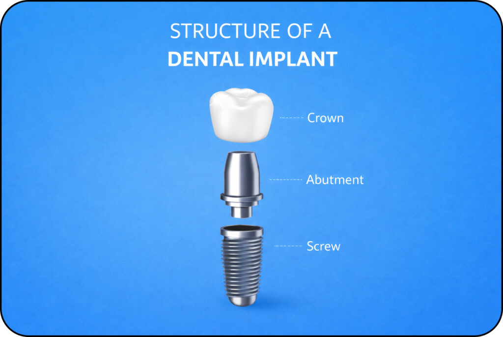 structure of a dental impant