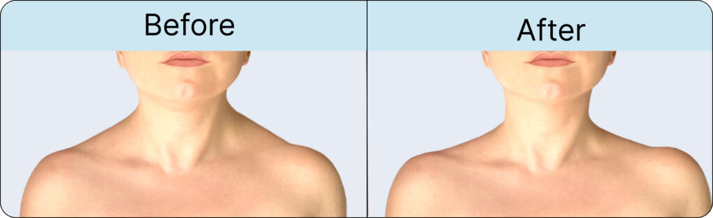 Botox in Traps Before and After