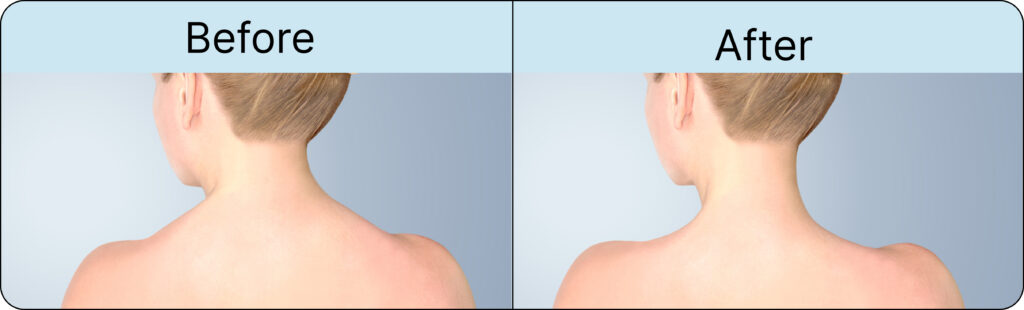 Botox in Traps Before and After 2